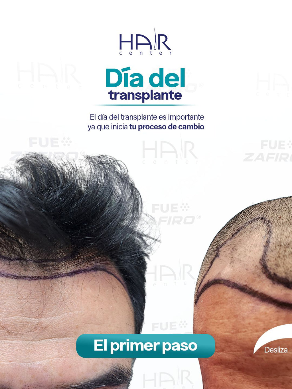 Implante Capilar