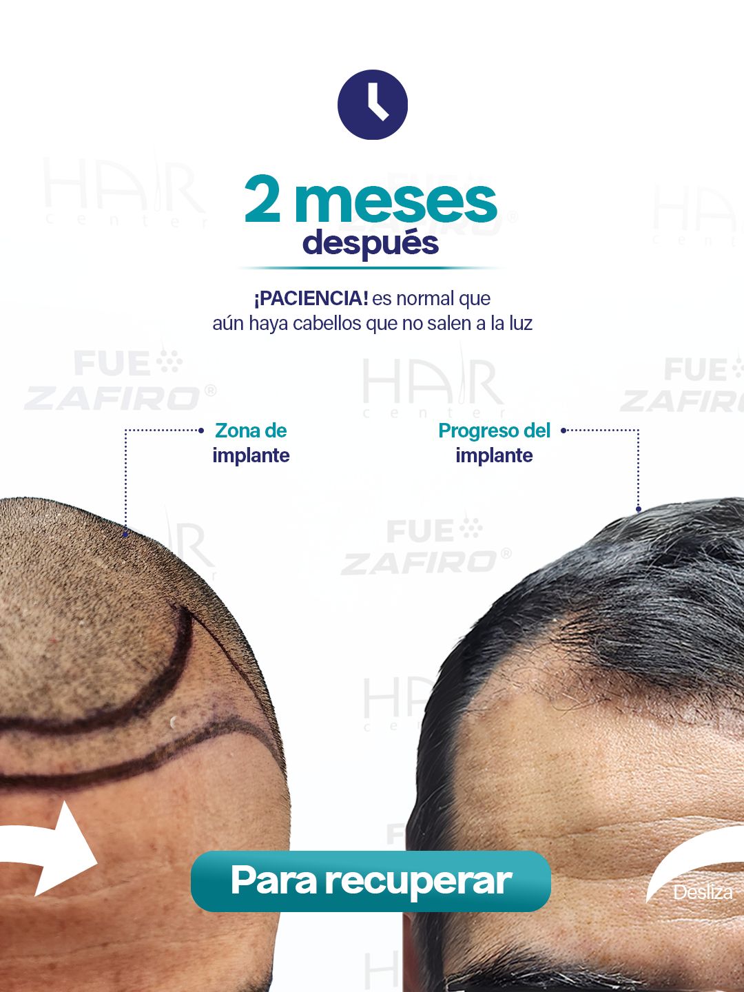 Implante Capilar