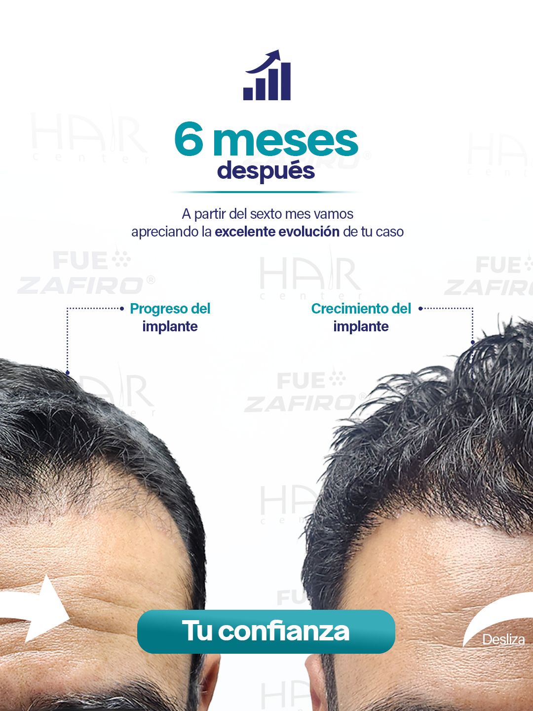 Implante Capilar