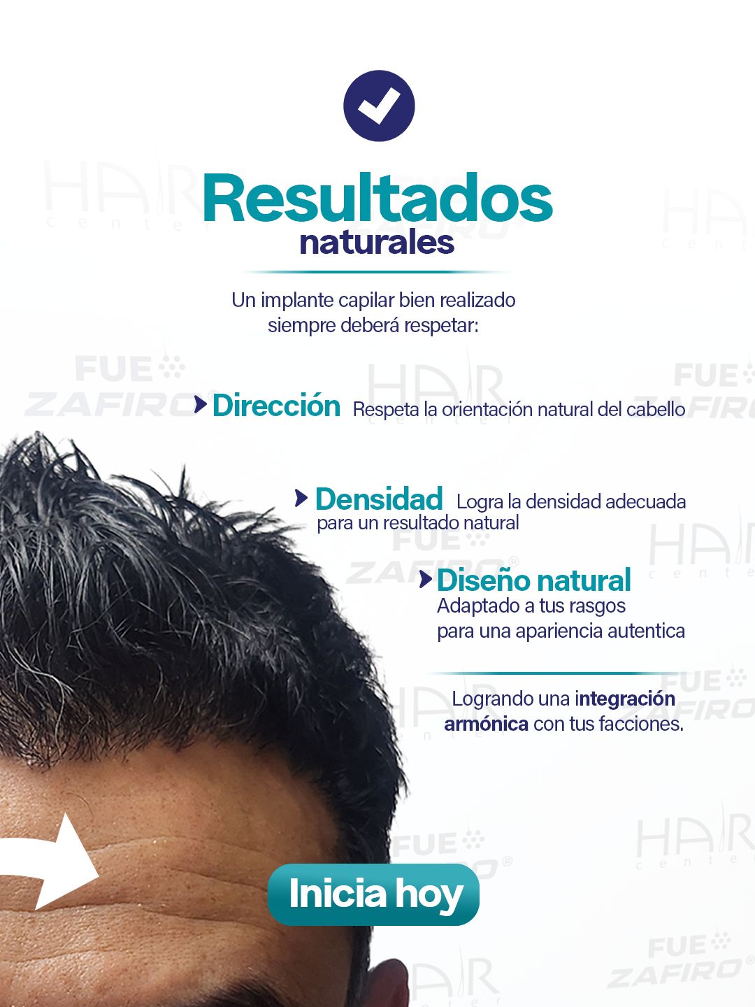 Implante Capilar