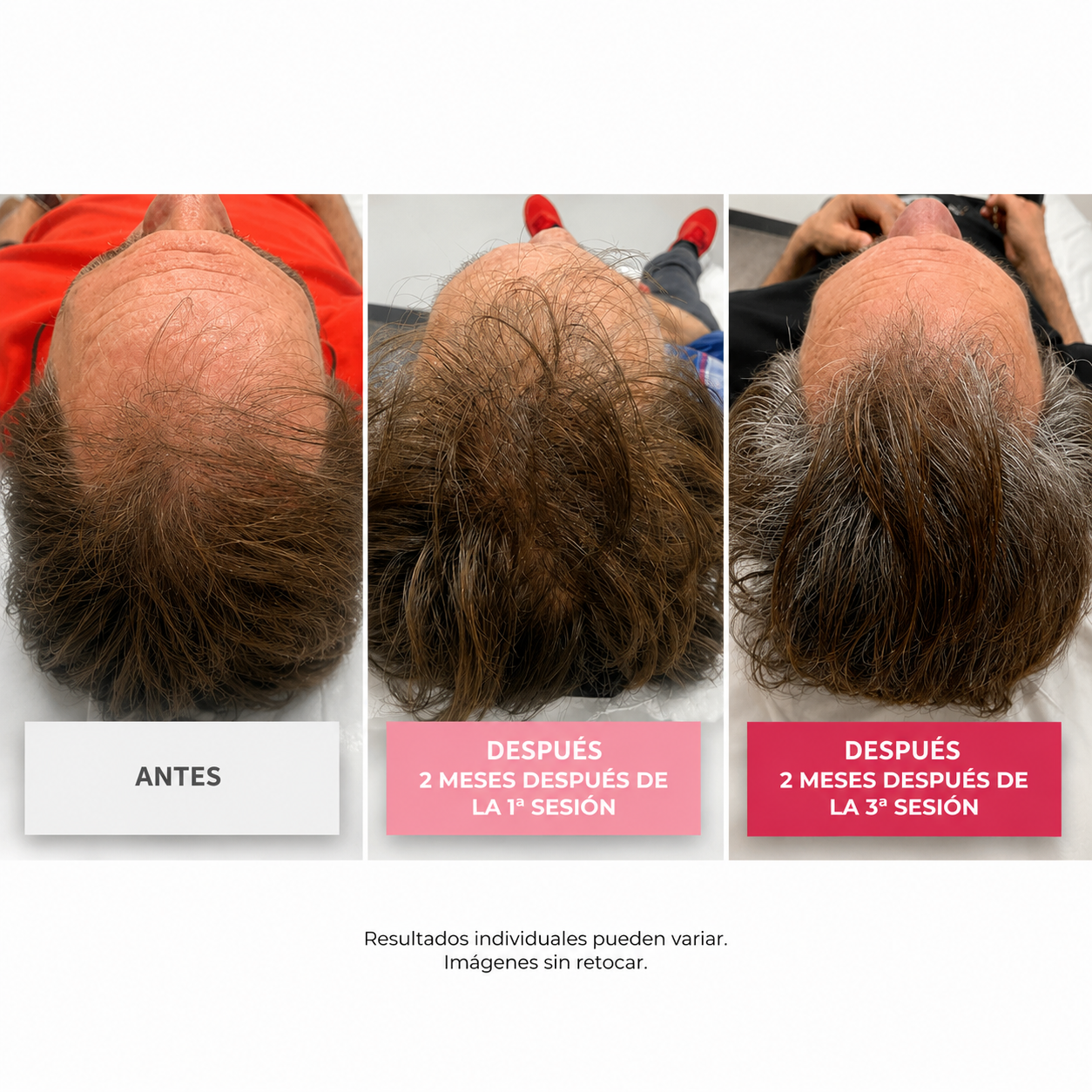 Purasomes HSC50+ Exosomas para el crecimiento capilar y contra la caída del cabello
